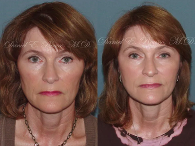 Laser Resurfacing before and after photo