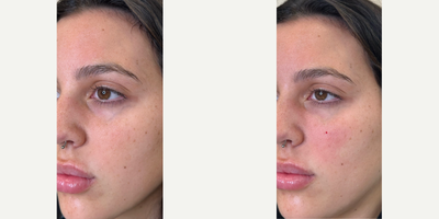 Restylane before and after photo