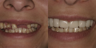 Smile Makeover before and after photo