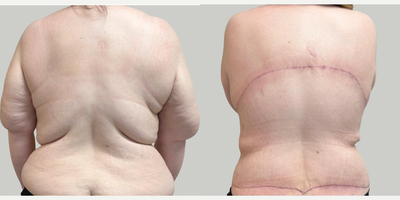 Body Lift before and after photo