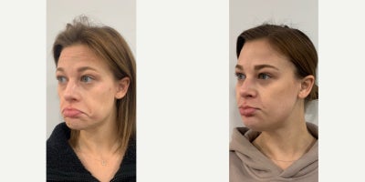 Botox before and after photo