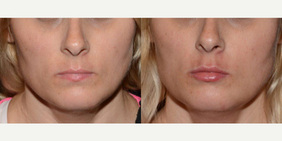 Lip Fillers before and after photo
