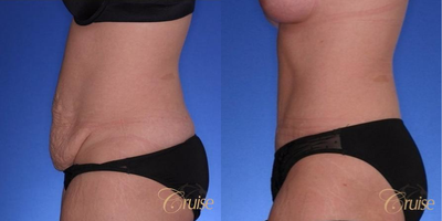 Tummy Tuck before and after photo