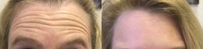 Botox before and after photo