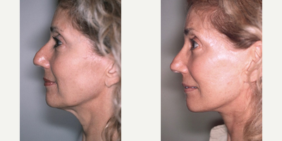 Facelift before and after photo