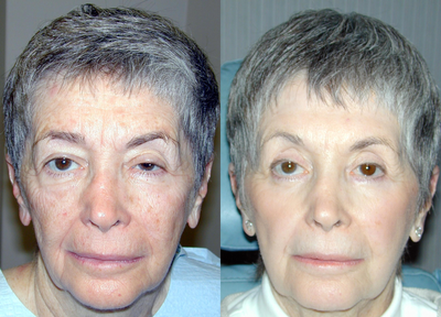Fraxel Laser before and after photo