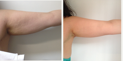 Arm Lift before and after photo