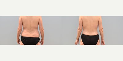 Mommy Makeover before and after photo