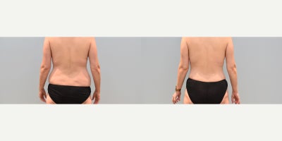 Mommy Makeover before and after photo