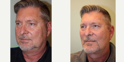 Neck Lift before and after photo