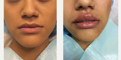 Vollure before and after photo