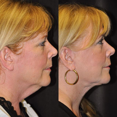 Facelift before and after photo