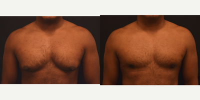 Gynecomastia Surgery before and after photo