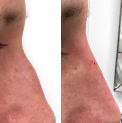 Nonsurgical Nose Job before and after photo