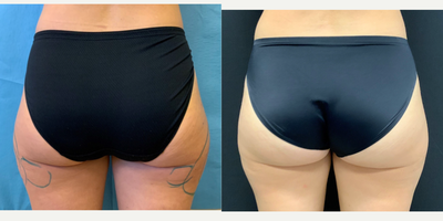SAFELipo before and after photo