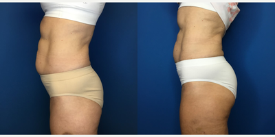 CoolSculpting before and after photo