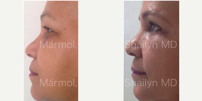 Eyelid Surgery before and after photo