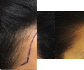 Hair Transplant before and after photo