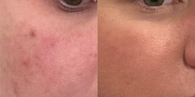 Halo Laser before and after photo
