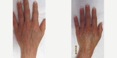 Hand Rejuvenation before and after photo