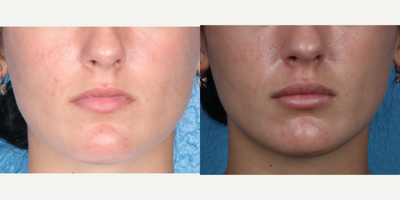 Lip Fillers before and after photo