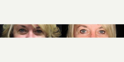 QuickLift before and after photo