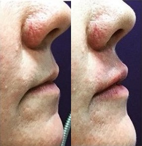 Microneedling before and after photo