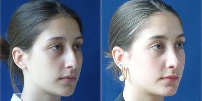 Rhinoplasty before and after photo
