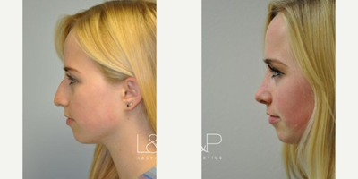 Rhinoplasty before and after photo