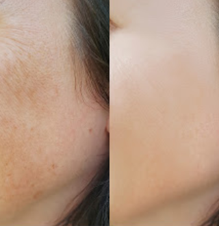Skin Lightening before and after photo