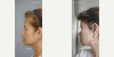 Brow Lift before and after photo
