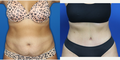 Drainless Tummy Tuck before and after photo