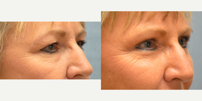 Eyelid Surgery before and after photo