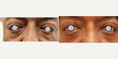 Eyelid Surgery before and after photo