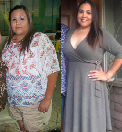 Gastric Sleeve Surgery before and after photo