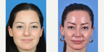 Rhinoplasty before and after photo