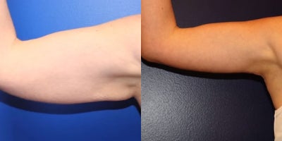 Arm Lift before and after photo