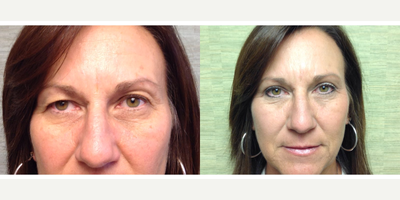 Eyelid Surgery before and after photo