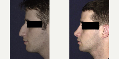 Rhinoplasty before and after photo