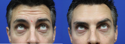Botox before and after photo