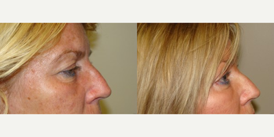 Brow Lift before and after photo