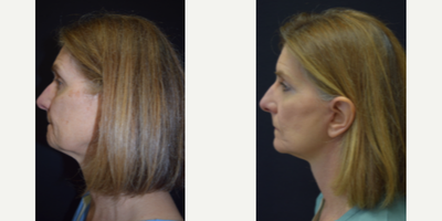 Facelift before and after photo