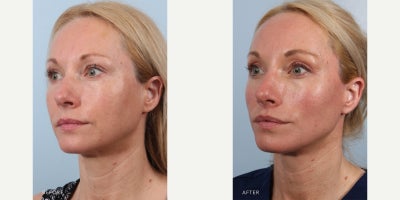 Lip Lift before and after photo