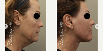 Neck Lift before and after photo