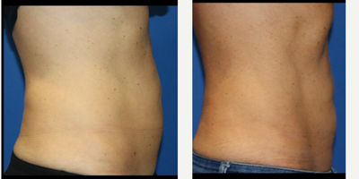 Emsculpt before and after photo