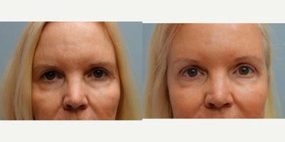 Eyelid Surgery before and after photo