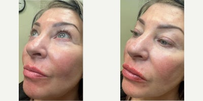 Lip Fillers before and after photo
