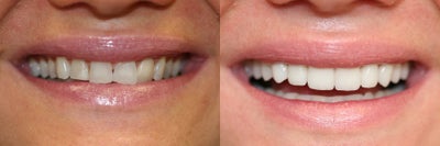Smile Makeover before and after photo