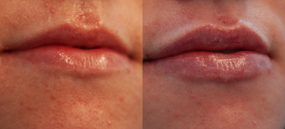 Dermal Fillers before and after photo