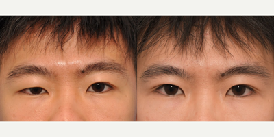 Double Eyelid Surgery before and after photo
